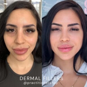 dermal filler before and after