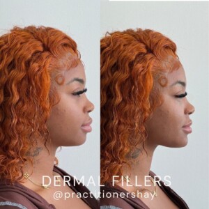 dermal filler before and after