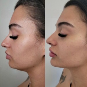 Women Chin filler Before and After