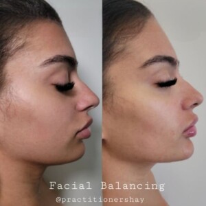 chin filler before and after for women
