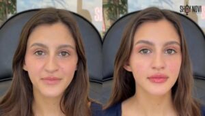 cheek-filler-before-and-after