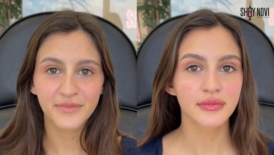 Cheek Filler Before and After: What Results Can You Expect?