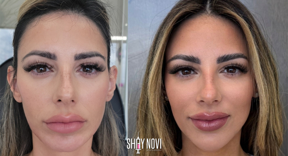 Why Do More People Choose Facial Balancing Fillers Over Surgery?