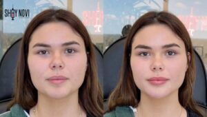 fillers-for-smile-lines-effectiveness