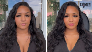 how-long-do-lip-fillers-last
