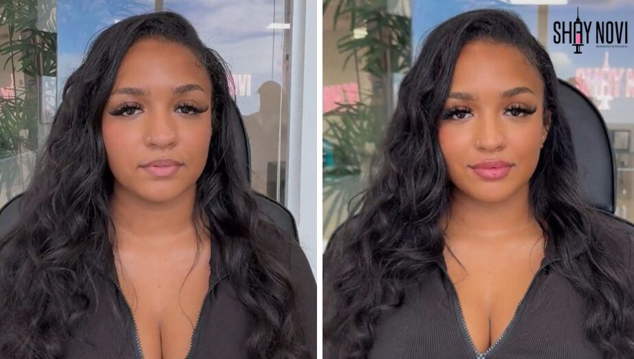 How Long Do Lip Fillers Last? Results, Maintenance & Tips