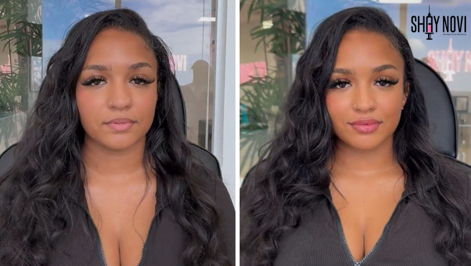 How Long Do Lip Fillers Last? Results, Maintenance & Tips