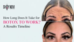 how-long-does-it-take-for-botox-to-work