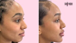 is-chin-filler-worth-it