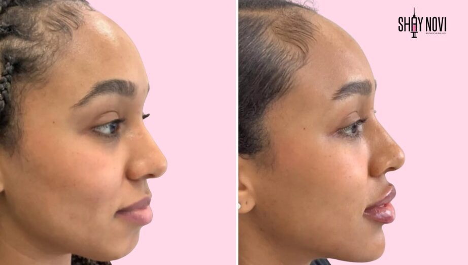 Is Chin Filler Worth It? Benefits, Results, and Expert Advice