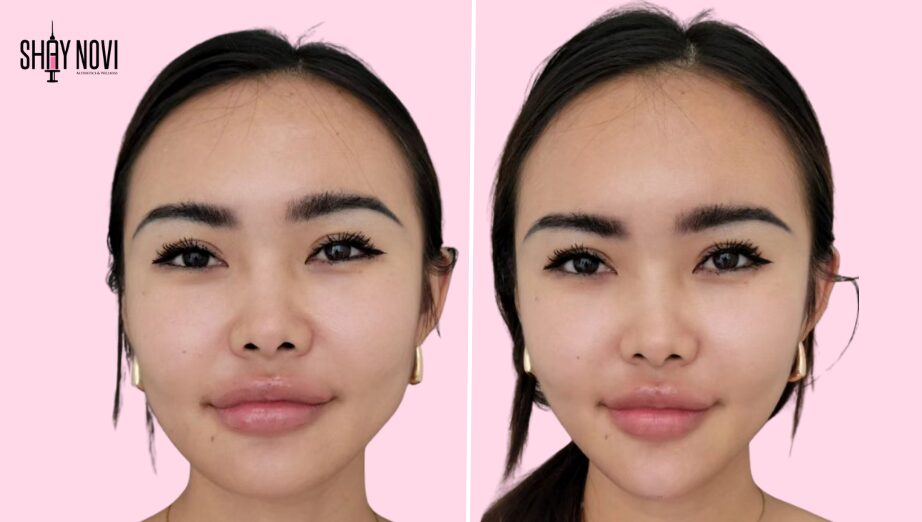 Non-Surgical Facial Balancing: A Modern Alternative to Traditional Facelifts