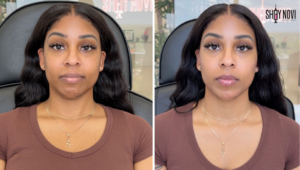 undetectable-filler-trend