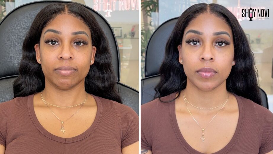 What Is the Undetectable Filler Trend? A Guide to Natural-Looking Results