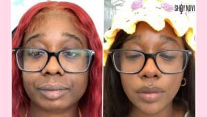 what-does-chin-filler-do