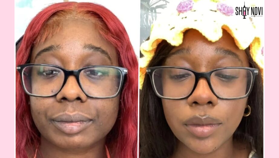 What Does Chin Filler Do for Your Side Profile and Jawline?