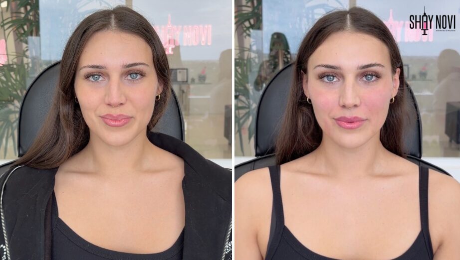 What Makes Facial Balancing Look Natural? Key Factors Behind Results